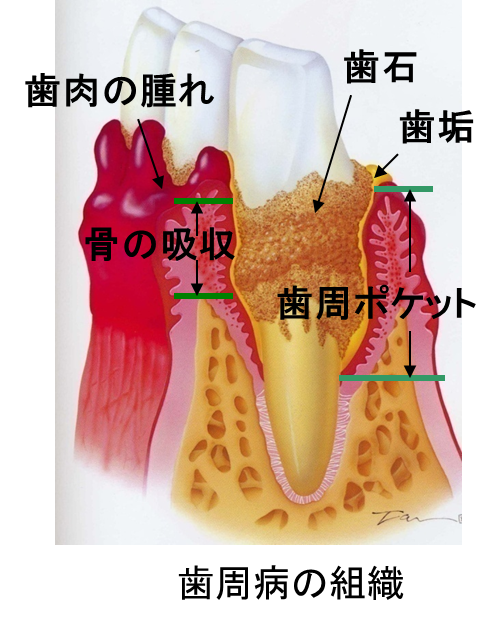 歯周病の組織