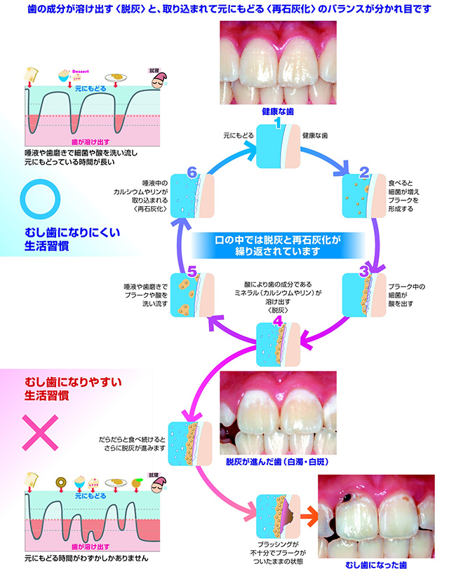 歯の成分が溶け出す<脱灰>と、取り込まれて元にもどる<再石灰化>のバランスが分かれ目です