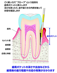 歯周ポケット検査