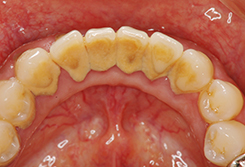 初期の歯周病の場合1