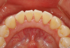 初期の歯周病の場合2